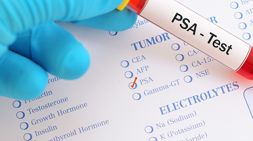 PSA Test – What you Need to Know